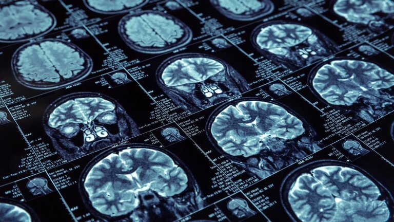 Stopping Cognitive Decline? Scientists Just Discovered the Protein Driving the Spread of Alzheimer’s